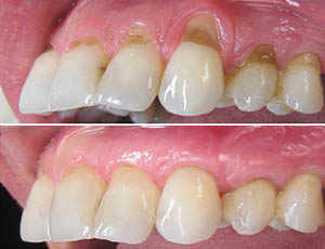 Connective graft