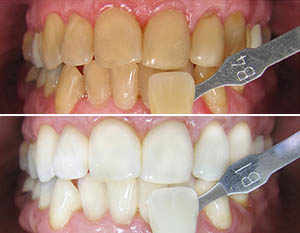 Dental whitening