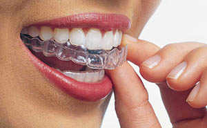 Invisalign