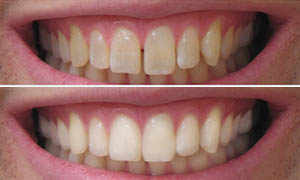 porcelain veneers