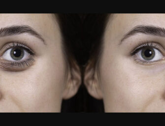 Botox fact-finding: <br>the before and after