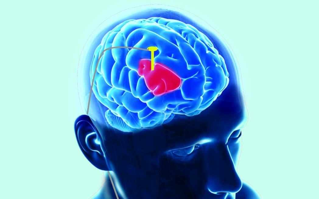 deep-brain-stimulation_westmountmag